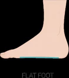 Flat Arch