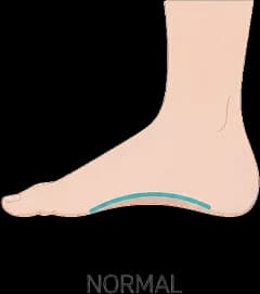 Normal Arch